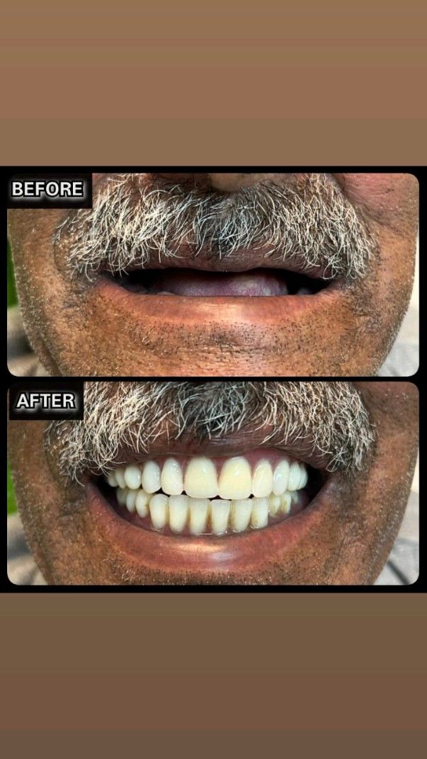 Patient with new dentures